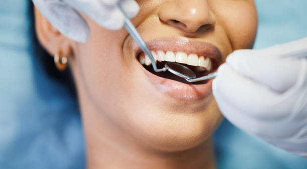 Best Broken or Chipped Tooth Repair in Butte, MT