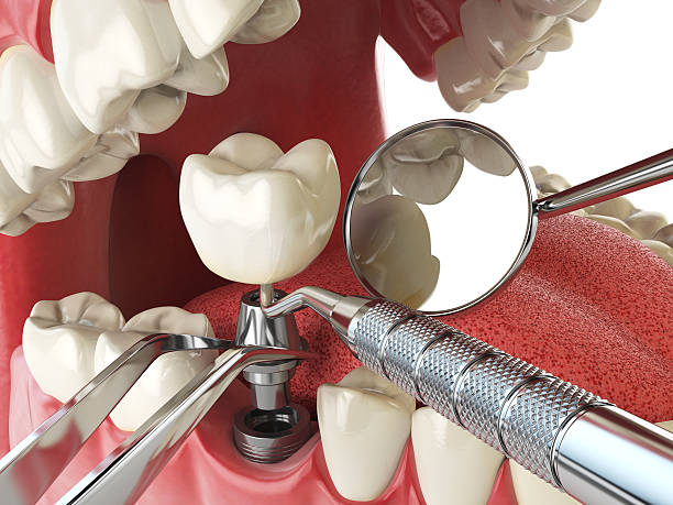 Best Knocked-Out Tooth (Avulsed Tooth) Treatment in Butte, MT